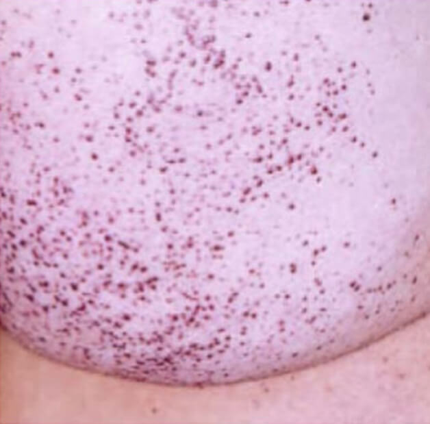 Fabry disease diagnosis - Typical angiokeratoma on the skin