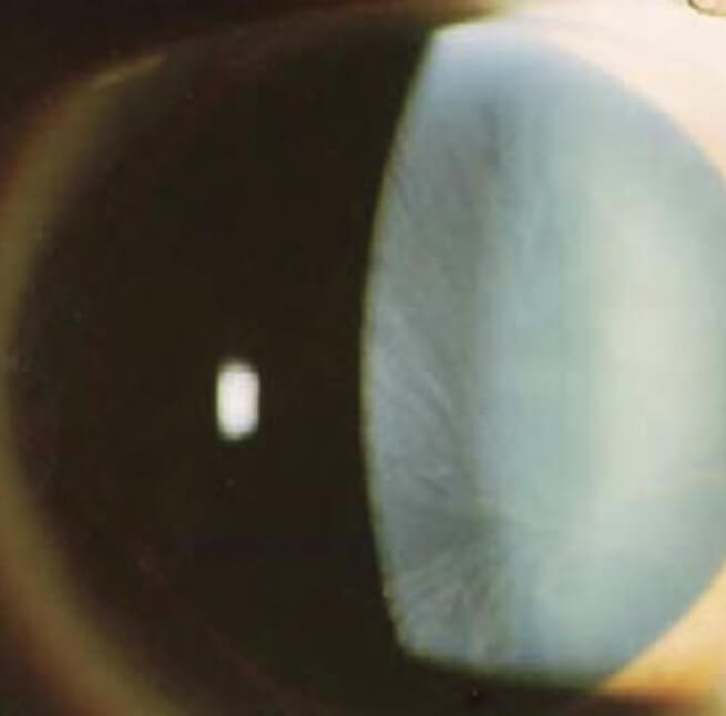 Fabry disease diagnosis - Cornea verticillata in a patient