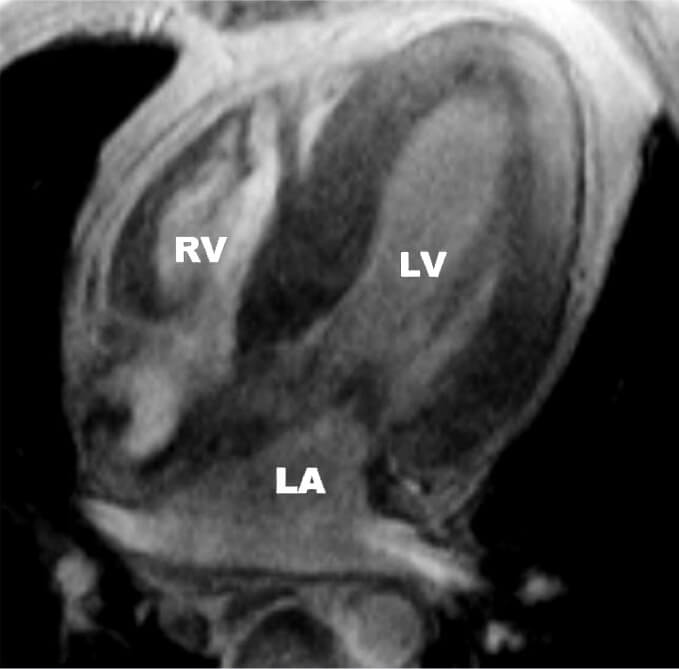 Fabry disease diagnosis - MRI of the heart of a patient with Fabry disease