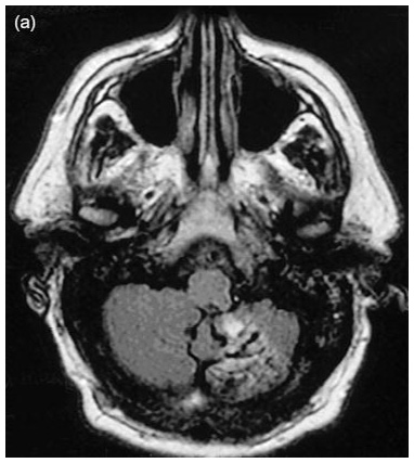 Fabry disease neurological symptoms: Magnetic resonance imaging - Left cerebellar hemisphere stroke