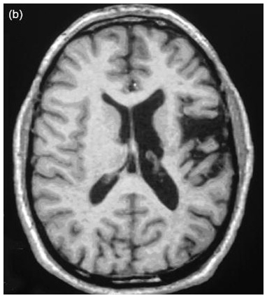 Fabry disease neurological symptoms: Magnetic resonance imaging - A left middle cerebral stroke