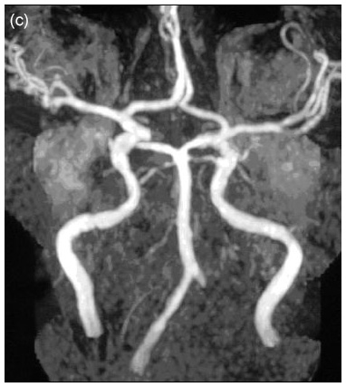 Fabry disease neurological symptoms: Magnetic resonance imaging - Occlusion of the left vertebral artery