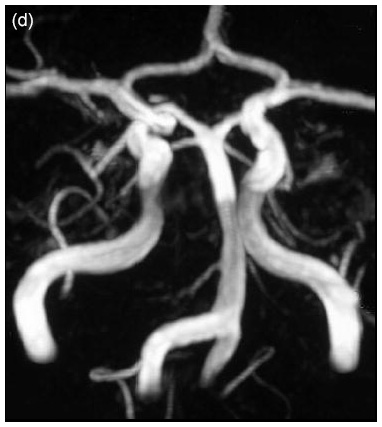 Fabry disease neurological symptoms: Magnetic resonance imaging - Dilation of the carotid arteries